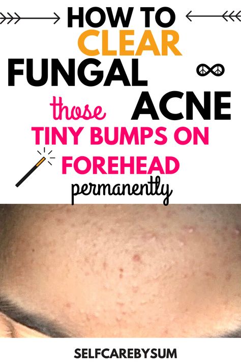 How to clear fungal acne: those tiny bumps on forehead - Self-Care by Sum #acne #pimples #pimplesremedies #acneremedies #skincarediy. https://whispers-in-the-wind.com/combatting-pimples-under-the-skin-expert-tips-and-product-recommendations/?135 How To Treat Fungal Acne, Fungal Acne Skin Care Routine, Tiny Bumps On Forehead, Acne On Forehead, Bumps On Forehead, Treat Fungal Acne, Small Bumps On Forehead, Small Bumps On Face, Forehead Bumps