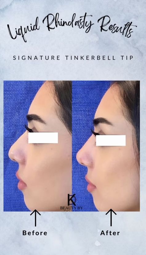 Dr. Kay’s signature “Tinkerbell Lift Tip” is the perfect way to get a cute, feminine nose without surgery! In addition to altering the tip, Dr. Kay can shape the bridge of the nose to smoothen any bumps or ridges. Tinkerbell Nose, Tinkerbell Tip Lift Nose, Nose Taping Results, Botox For Nose Tip, Pixie Tip Lift Nose Filler, Nose Tip Lift Botox Before And After, Cosmetic Procedures, Fat Burning, Lips