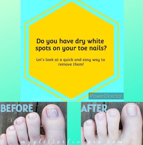 How To Get Your Nails White, White Spots On Fingernails, White Spots On Toenails, White Patches On Toenails, White Marks On Nails, How To Remove Nail Polish From Fabric, How To Remove Nail Polish With Remover, White Spots On Nails, Nail Problems