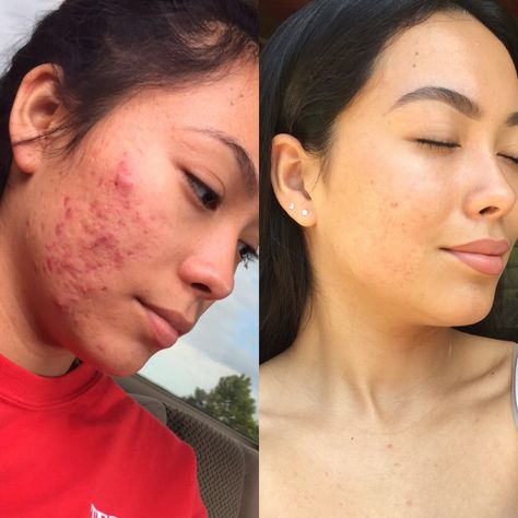 My before and after acne transformation ✨ I quit dairy 6 months ago and haven’t looked back! I have a new video on my YouTube channel talking more about it please check it out ❤️ https://youtu.be/CsubDPZwvvU Acne Before After, Before After Aesthetic, Skincare Before And After, Acne Before And After, Beef Tallow Face Cream, Acne Transformation, Tallow Face Cream, Tallow Moisturizer, Girl With Acne