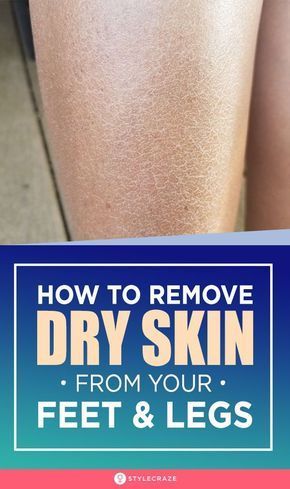 Dog Dry Skin Remedy, Dry Skin Legs, Newborn Dry Skin, Ichthyosis Vulgaris, Dryskin Skincare, Baby Dry Skin, Best Foundation For Dry Skin, Dry Skin Diy, Primer For Dry Skin