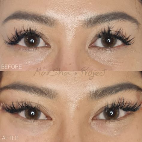 Fox Eye Thread Lift Before And After, Fox Eye Lift Surgery, Pdo Threads Under Eyes, Cat Eye Surgery Before And After, Fox Eye Surgery Before And After, Cat Eye Surgery, Upturned Almond Eyes, Fox Eye Thread Lift, Fox Eye Surgery