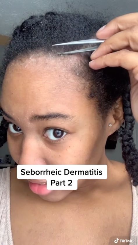 camelialariss on Instagram: Part ✌🏽:Seborrheic Dermatitis This is what I’m scalp looks like when it has either flare up or after washing my hair from waiting too… Dermatis Seborrheic, Sensitive Scalp Remedies, Sebhorric Dermitis Scalp, Sebhorric Dermitis, Sebboric Dermitis Scalp, Scalp Psorasischic, Scalp Psorasischic Remedies, Seborrheic Dermitis On Face, Seborrheic Dermitis On Scalp