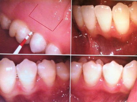 Soft Foods To Eat, Gum Graft, Dental Bridge Cost, Gum Removal, Gum Surgery, Gum Recession, Skin Grafting, Teeth Whitening Diy, Emergency Dentist