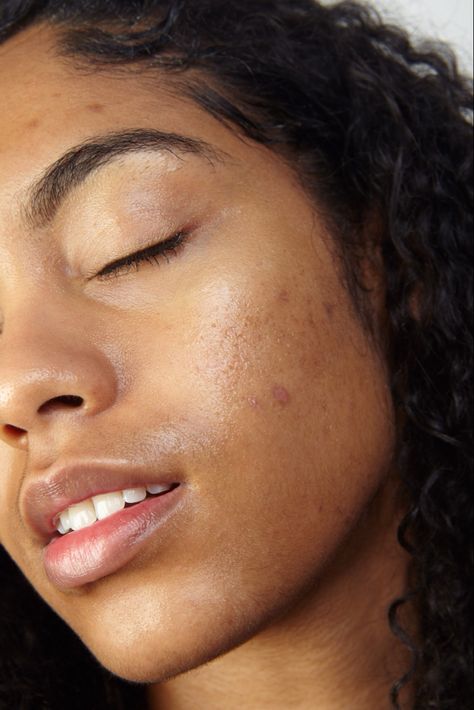 Imperfect Skin, Dark Spots On Face, Natural Beauty Remedies, Vegan Skincare, Youthful Skin, Diy Skin Care, Skin Conditions, People Photography, Just The Way