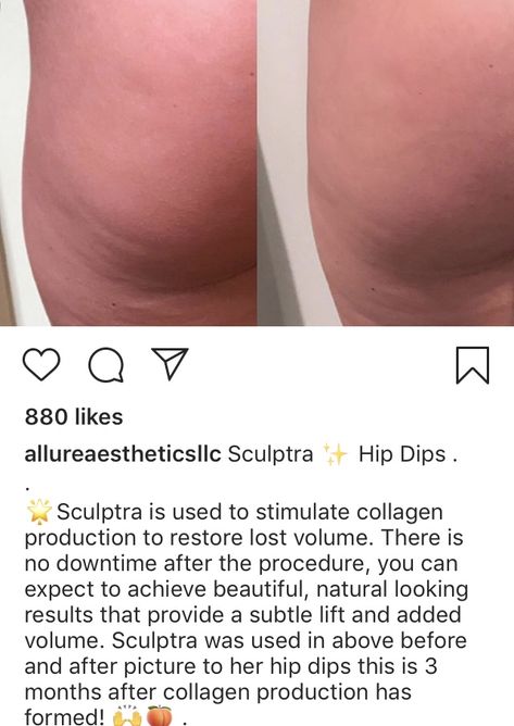 Sculptra Before And After, Hip Dips Before And After, Hips Dips Before And After, Celebs Without Makeup, Hips Dips, Random Inspiration, Diy Beauty Recipes, Work Outs, Med Spa