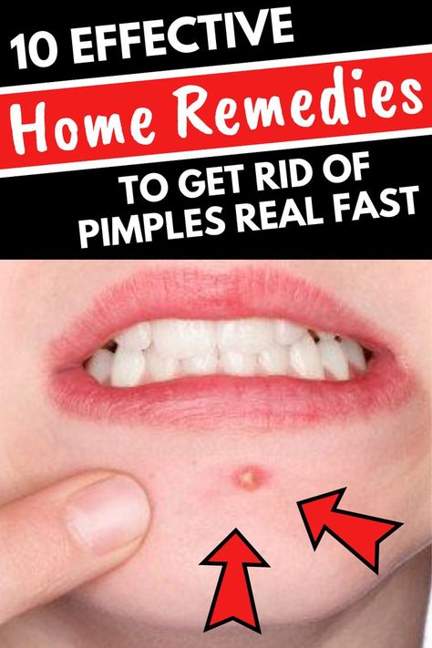 How To Get Rid Of A Pimple Fast At Home, How To Treat Papules Acne, How To Get Rid Of Zits Overnight, How To Get Rid Of A Pimple In 5 Minutes, How To Get Rid Of Zits, Get Rid Of Zits Overnight, How To Get Rid Of Pimples Overnight, Papules Acne, Dettol Antiseptic