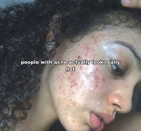 Girl With Acne, People With Acne, Bad Acne, Skin Condition, Bare Beauty, Face Acne, Pretty Skin, Best Skin, I Feel Good