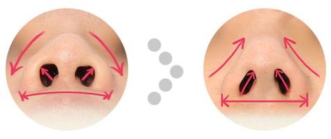 How to fix flat, wide nose in one day. ☞Here we have a quick, easy, long-lasting solution for your wide, flat, thick, bulbous nose that can be done in just 10 minutes. Why is this K-Nose So Awesome? How is it possible in just 10 short minutes? Take a look and get your mind blown! K-Nose : One day Nose job, more specifically, Non-incision nasal tip-plasty is a procedure using specially-designed thread to reshape, refine, correct the nose(nasal) tip leaving no scars from surgical incision. - See m Thick Nose Rhinoplasty, Tip Plasty Nose, Nose Fillers, Short Nose, Crooked Nose, Bulbous Nose, Nose Reshaping, Nose Jobs, Rhinoplasty Surgery