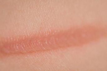 How to Get Rid of Burn Marks on the Skin with Home Remedies. At least once in our lives, we Burn Mark, Fitness Journal, Dehydrated Skin, Simple Doodles, The Skin, Skillet, Home Remedies, The Kitchen, Healing