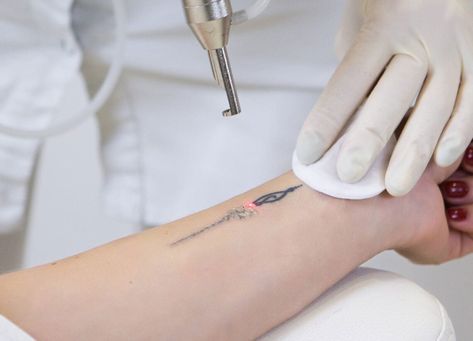 Picosure Tattoo Removal, Tattoo Removal Cost, Trending Tattoo, Laser Removal, Omerta Tattoo, Laser Clinics, Laser Tattoo, About Tattoo, Laser Tattoo Removal