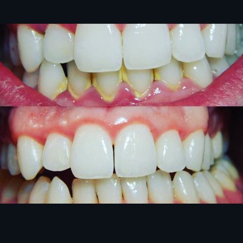 Tartar or hardened dental plaque will lead to calculus which compromises the health of your gums. Happy patient with no yellow rings around her teeth #gotothedentist #brushandfloss #getcleanings #hygienist #dentaloffice #dentistinencinitas Plaque Teeth, Dental Plaque, Plaque Removal, Best Teeth Whitening, How To Prevent Cavities, Receding Gums, Oil Pulling, Gum Health, Tooth Decay