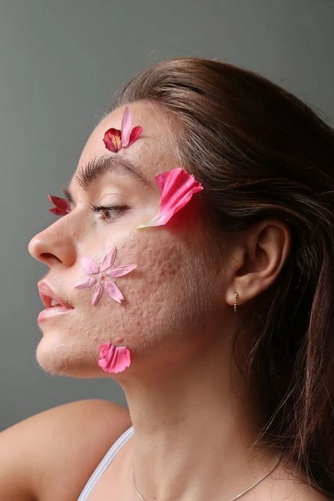 "Skin is not good or bad; it’s not a point of conversation": Decoding the skin neutrality movement | Vogue India #SkinPositivity #FreetoBeMe #Skin Acne Photography Beauty, Photography Of Insecurities, Skin Positivity Aesthetic, Bad Skin Pictures, Skin Imperfections Photography, Body Neutrality Photography, Body Positive Photography Ideas, Body Acne Positivity, Women Body Positive Photography