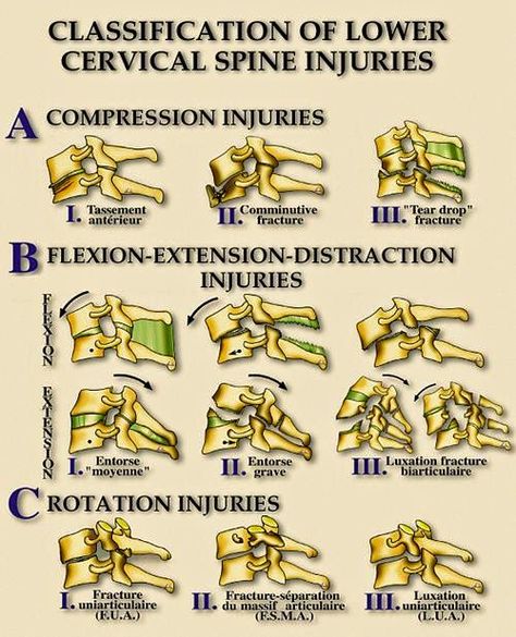 Thoracic and Cervical Spine Injury | RadTechOnDuty Spine Injury, Spinal Cord Injuries, Radiology Technician, Spinal Surgery, Cervical Spine, Spine Surgery, Nursing School Notes, Human Anatomy And Physiology, Medical Terminology