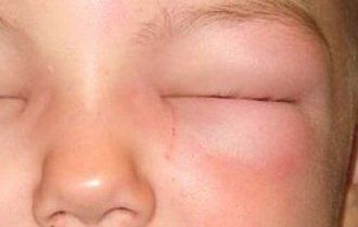 Swollen Eyelids Remedy, Swollen Eye Remedies, Itchy Eyelids, Swollen Eyelid, Puffy Eyes Remedy, Allergy Eyes, Swollen Eyes, Upper Eyelid, Allergy Relief