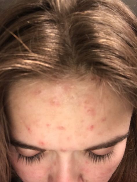 Dermatilloma Tips, Symptoms Of Manic, Trichotillomania Tips, Hair Pulling Disorder, Face Picking Disorder, Skin Picking Disorder, Histrionic Personality Disorder, Anger, Health