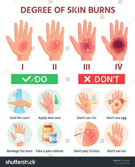 Burn Wound, First Aid For Burns, Emt Study, Burn Injury, First Aid Tips, Degree Burns, Survival Skills Life Hacks, Skin Burns, Safety And First Aid