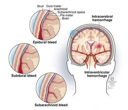 Brain Bleed, Intracranial Hemorrhage, Subarachnoid Hemorrhage, Types Of Strokes, Brain Surgeon, Arteries And Veins, Breakfast Easy, Anatomy Physiology, Medical Questions