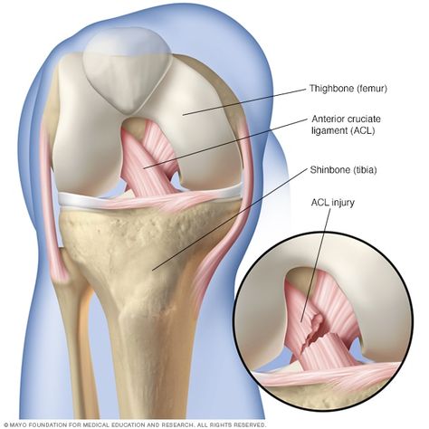 ACL injury - Symptoms and causes - Mayo Clinic Acl Injury, Acl Recovery, Acl Surgery, Anterior Cruciate Ligament, Ligament Tear, Acl Tear, Ligament Injury, Cruciate Ligament, Knee Pain Relief