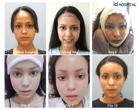 Xiomary had a total transformation at ID Hospital. She had V-line surgery, forehead reduction, fat6 graft and thread lift. #idhospital #idhospitalkorea #plasticsurgery #koreanplasticsurgery #surgeryinkorea #facialcontouring #koreanplasticsurgerybeforeandafter #Vlinesurgery Forehead Reduction Surgery, Forehead Reduction, Hospital Surgery, Face Plastic Surgery, V Line Surgery, Forehead Lift, Korean Plastic Surgery, Plastic Surgery Photos, Face Surgery