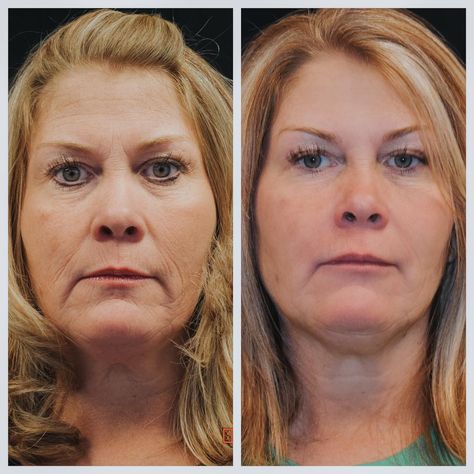 The Real Deal on Fillers - Lola Magazine Filler For Marionette Lines, Marionette Lines Before And After, Marionette Lines Filler, Juvederm Before And After, Lip Line Filler, Botox Wrinkles, Feeling Old, Chin Filler, Face Fillers