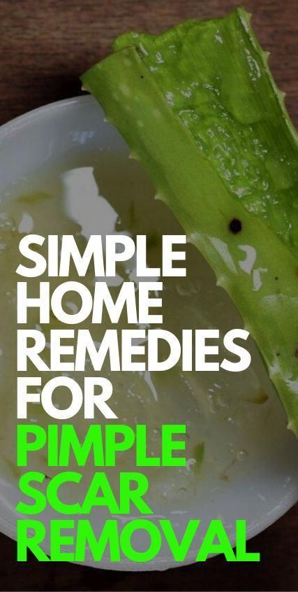 Nobody likes pimples obviously. The best way to keep your skin free of pimple marks is to prevent breakouts. 10 Pimple Scar Removal Tips Pimple Scars Removal, Pimples Remove Tips For Men, Pimple Under The Skin, Pimple Scar Removal, Scar Remedies, How To Clear Pimples, Home Remedies For Pimples, Get Rid Of Pimples, Blind Pimple