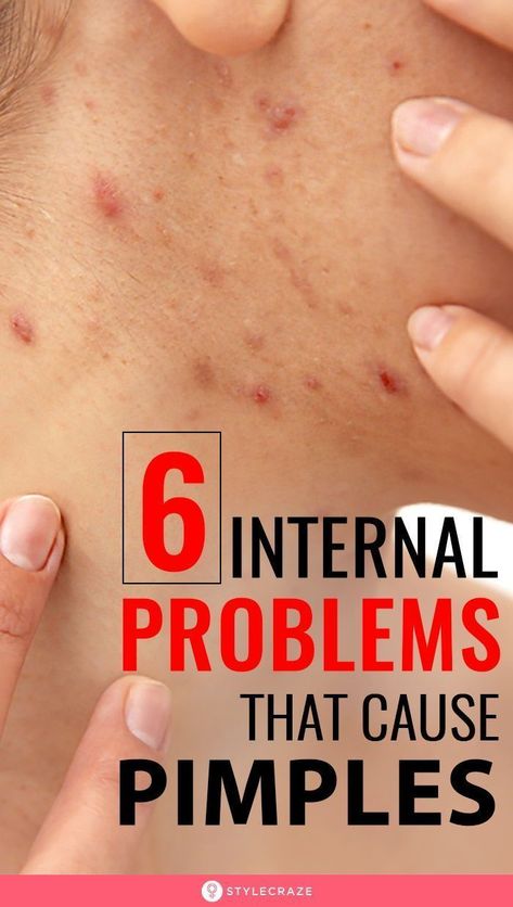 Cheek Pimples, What Causes Pimples, Cheek Acne, Painful Pimple, Pimple Causes, Blind Pimple, Pimples Under The Skin, Pimples Overnight, Acne Overnight