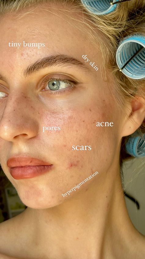 People With Acne Pretty, Imperfect Skin Aesthetic, Beautiful Girls With Acne, Clean Girl With Acne, Pretty Acne Aesthetic, Romanticizing Acne, Acne Aesthetic Girl, Acne Girls Pretty, Acne Skin Aesthetic