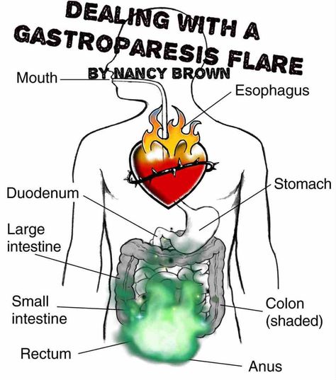 Dealing with a Gastroparesis Flare by Nancy Brown 7/3/17   What is a Gastroparesis Flare? A medical flare is defined as a temporary worsening of symptoms of a disease or condition.  A gastropa… Gastric Problem, Gastrointestinal Disease, Reflux Symptoms, Acid Reflux, Autoimmune Disease, Air Fryer, Disease, Medical, Human