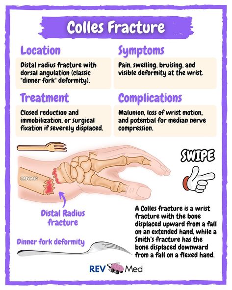 If you can’t tell… we’re Yankees fans over here… 🗽⚾️ Who do you think will win the World Series? PS: We have a list of common FOOSH injuries from hand to shoulder listed below ⤵️ You can never count out a Yankee… believe that. More lessons and high yield notes coming your way. Follow the page 👉🏼 @rev.med FOOSH (Fall On Outstretched Hand) Injuries ✅ Wrist & Hand Scaphoid Fracture *Most common carpal bone fracture, often in young adults  Distal Radius Fractures *Colles Fracture: Dorsal ang... Hip Fracture Nursing, Colles Fracture, Distal Radius Fracture, Medical Hacks, Scaphoid Fracture, Anatomy For Kids, Emt Training, Ipad Pro Notes, Outstretched Hand