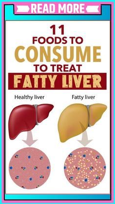 Fatty Liver Diet Plan And Foods To Eat And Avoid Liver Diet Plan, Liver Diet Recipes, Healthy Liver Diet, Natural Liver Detox, Health Women, Liver Diet, A Diet Plan, Healthy Liver, Liver Detox