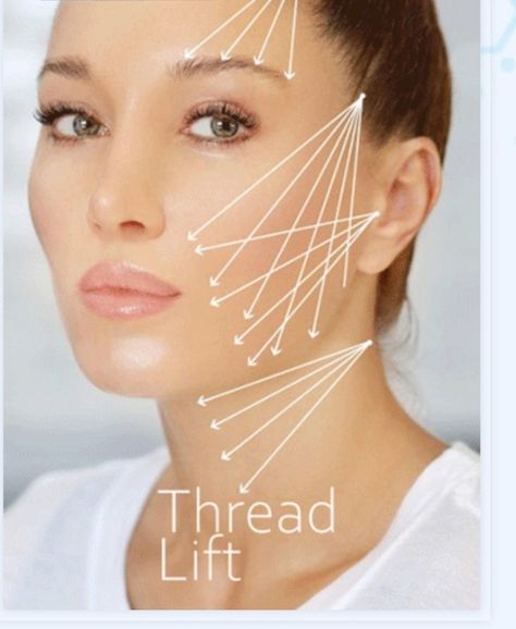 Thread Lift Face, Eyebrow Lift, Marionette Lines, Thread Lift, Tissue Types, Cosmetic Injectables, Face Lifting, Facial Plastic, Medical Aesthetic