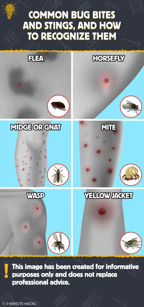 Gnat Bites, Mosquito Bite Itch, Wasp Stings, Itchy Rash, Secret House, Mosquito Bite, Bug Bites, Insect Bites, Square Card