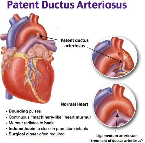 Cath Lab Nursing, Respiratory Therapist Student, Patent Ductus Arteriosus, Cardiac Sonography, Medical Terminology Study, Nurse Teaching, Lpn Schools, Nursing School Essential, Heart Diseases