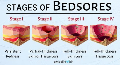 Bed Sores Remedies, Pressure Ulcer Staging, Bed Sores, Pressure Ulcer, Subcutaneous Tissue, Progesterone Levels, Armpit Fat, Poor Nutrition, Nursing School Studying