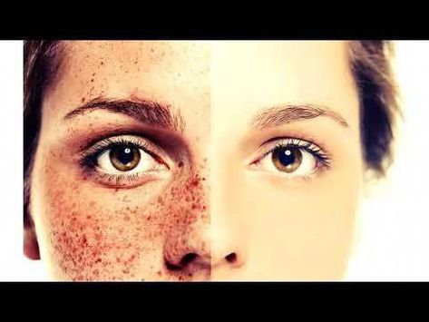 Do you want to stop having freckles? Don't you have time to watch very long subliminal videos? Now you can do it in just 10 minutes!Subliminal messages are t... How To Remove Freckles, How To Get Freckles, Age Spot Remedies, Getting Rid Of Freckles, Freckle Remover, How To Do Eyeshadow, Age Spots On Face, Age Spot Removal, Freckles Makeup