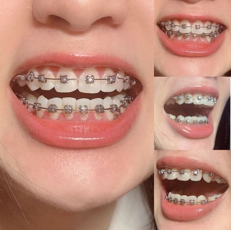 Brackets Aesthetic, Cute Braces Colors, Teeth Aesthetic, Braces Tips, Getting Braces, Braces Girls, Cute Braces, Windows To The Soul, Brace Face