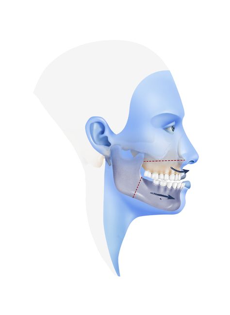 Orthognathic Surgery, Character Animation, Green Screen, Animated Characters, Surgery, Eye Makeup, Facial, Medical, Screen