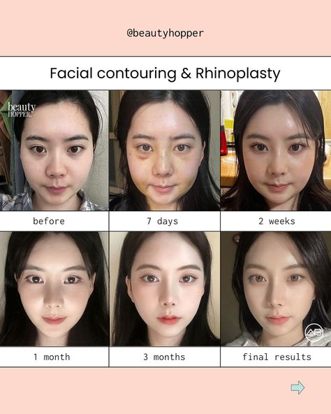 Changing your facial shape and proportion can be an extremely powerful tool to amplifying your beauty✨ For the above procedures, we recommend you to stay a minimum of 2 weeks in Korea. 👉🏻Whether you are seeking a subtle refinement or a more dramatic transformation, we can guide you to the best surgeon capable of achieving the aesthetic you desire. We’re here to help you have a safe and successful makeover in Korea. Contact us for a free consultation ⬇️⬇️⬇️ 💌: contact@beautyhopper.com 📲... Korean Plastic Surgeries, Korean Plastic Surgery Before And After, Korean Nose Job, Korean Surgery, Kpop Plastic Surgery, Jaw Reduction Surgery, Beauty Surgery, Nose Plastic Surgery, Change Appearance