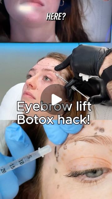 Dr Tim Pearce on Instagram: "Here’s a tip for creating a subtle brow lift with Botox 💉" Brow Lift Botox Eyebrows, Botox Results, Botox Injection Sites, Botox Brow Lift, Eyebrow Lift, Botox Injections, Brow Lift, Eye Lift, Best Eyebrow Products