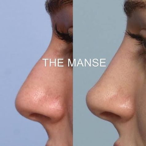 Luxury Clinic, Non Surgical Rhinoplasty, Nose Filler, Nose Surgery Rhinoplasty, Nose Fillers, Upturned Nose, Parts Of The Nose, Rhinoplasty Nose Jobs, Nose Reshaping