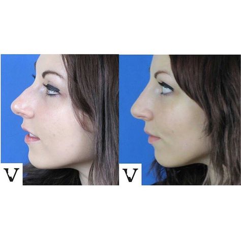 👃 Nose feeling a little bumpy? Smooth things over with a Liquid Rhinoplasty! Our patient wanted to enhance their natural beauty without going under the knife. With a few expertly placed fillers, we were able to subtly smooth out the dorsal hump, creating a more balanced and refined look. Love the results? Contact us today to schedule your consultation! ☎️ 617-795-0201 📧 info@VisageSculpture.com 💻 www.VisageSculpture.com #VisageSculpture #LiquidRhinoplasty #NonSurgicalRhinoplasty #FacialF... Liquid Rhinoplasty, Under The Knife, Natural Beauty, Feelings, Beauty, Quick Saves