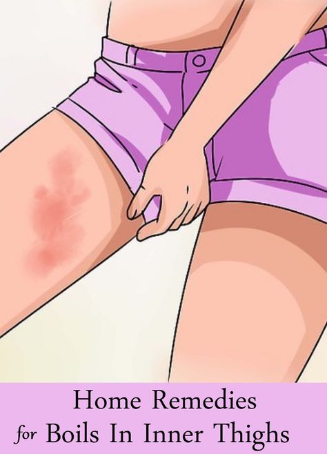 Home Remedies For Boils In Inner Thighs Inner Thigh Bumps, Inner Thigh Boils, Inner Thigh Rash, Boil Remedies, Get Rid Of Boils, Home Remedy For Boils, Skin Boil, Rashes Remedies, Thigh Rub