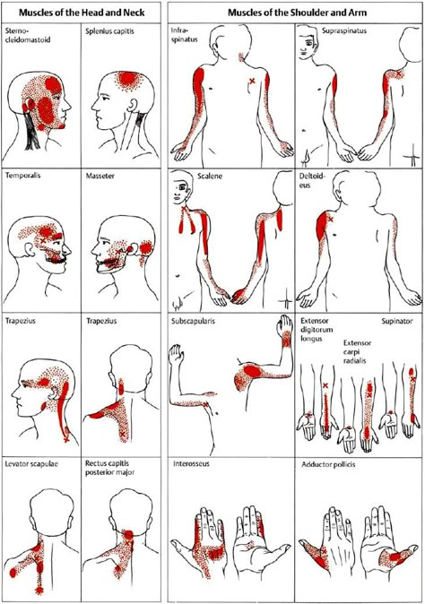 Examples of trigger points and referred pain in the reference sites (pain reference pattern; after Travell and Simons, 1983a). Myofascial Trigger Points and Pain Referral Patterns  Referred pain, in the presence of either an active or a latent MTrP, is usually very well-localized.  MTrP in the sternal region of the sternocleidomastoid muscle can cause satellite MTrPs in the sternalis muscle, pectoralis muscle, and the serratus anterior major muscle. MTrPs can be found in any skeletal muscle Trigger Point Referral Patterns, Muscle Trigger Points, Punkty Spustowe, Serratus Anterior, Sternocleidomastoid Muscle, Night Moth, Myofascial Pain Syndrome, Referred Pain, Basic Anatomy And Physiology