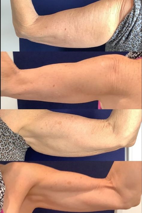 Before and after PHYSIQ BODY CONTOURING AVAILABLE AT SLATER AESTHETICS -Images courtesy of Cartessa from Femme Modern Center For Aesthetics. Electric Muscle Stimulator, Muscle Definition, Summer Bod, Muscle Stimulator, Workout Results, Muscle Tone, Body Sculpting, Body Contouring, Muscles