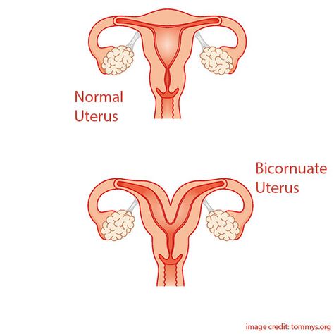 Bicornuate Uterus and it’s impact on a woman’s fertility Heart Shaped Uterus, Bicornuate Uterus, Uterine Polyps, Menstrual Health, Twin Pregnancy, Menstrual Cup, Us Images, Baby Grows, Fertility