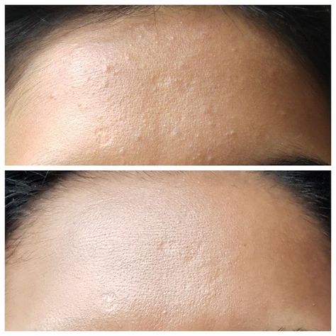 One Reddit user may have discovered a holy-grail product for removing whitehead blemishes from skin. Click here to see how it works. Whiteheads Remedy, Closed Comedones, Blind Pimple, Pimples Under The Skin, Natural Beauty Remedies, Natural Acne Remedies, Beauty Remedies, Acne Remedies, Unwanted Hair Removal