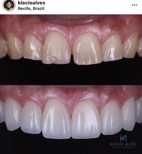 Before and after porcelain Veneers from doctor klecioalves.  The top photos is the before picture, the teeth are yellow and chipped. The Bottom photo is the after picture which is a perfect white smile. Teeth Surgery Before And After, Prosthodontics Day Posters, Dental Veneers Before And After, Teeth Veneers Before And After, Dental Crowns Before And After, Dental Before And After, Porcelain Veneers Before And After, Composite Veneers Before And After, Veneers Before And After