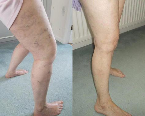 Heal Your Varicose Veins with a Mix of Aloe Vera, Carrot and Apple Cider Vinegar – RECIPE Thread Veins, Home Remedies For Spiders, Leg Ulcers, Varicose Vein Remedy, Cypress Essential Oil, Venous Insufficiency, Before After Photo, Smart Things, Cider Vinegar