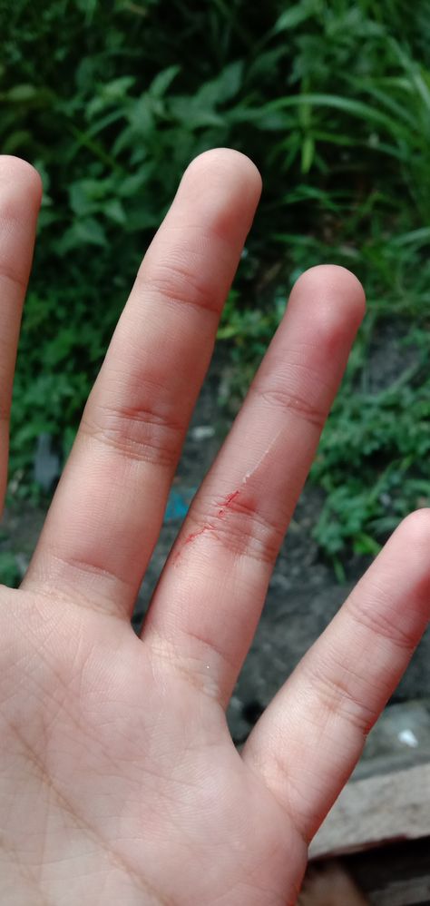 Pap Tangan Di Iris Kaca, Hand Hurt Fake Story, Hand Kata Pic Bled, Injury Fake Story, Toreh Tangan, Fake Sick, 2000 Wallpaper, Radha Beauty, Hospital Admit Hand Pics